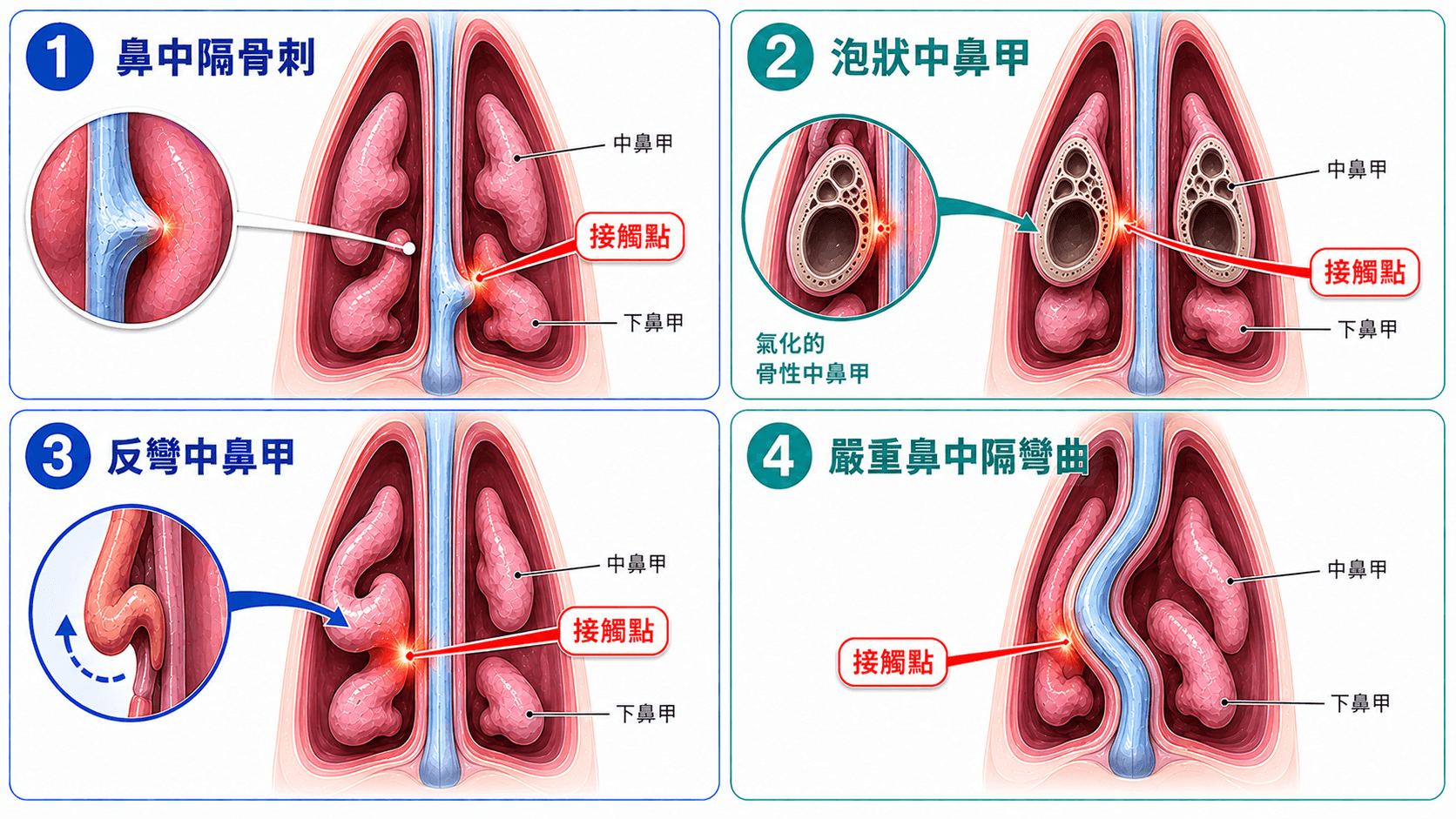 造成鼻黏膜接觸與接觸點頭痛的四種常見鼻腔結構異常示意圖