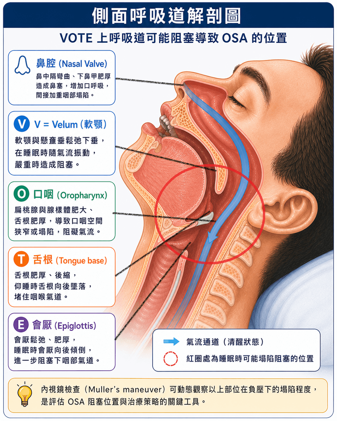 阻塞型睡眠呼吸中止症氣道解剖示意圖