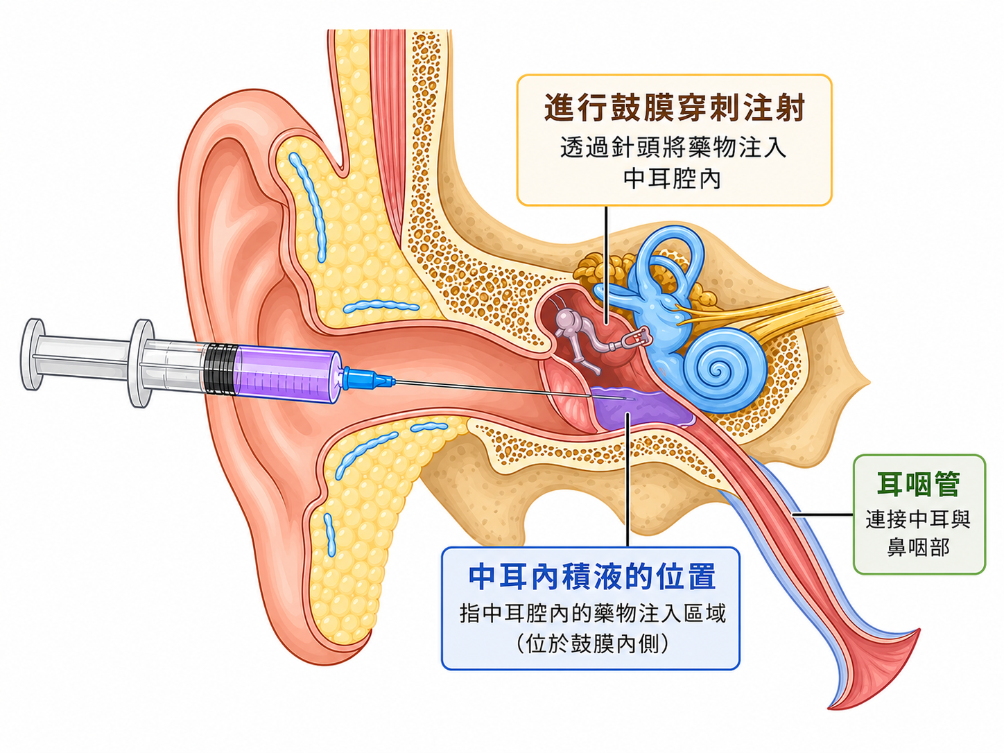 鼓室內類固醇注射示意圖:醫師透過針頭穿過鼓膜,將類固醇藥物直接注入中耳腔內,藥物經圓窗膜滲透至內耳