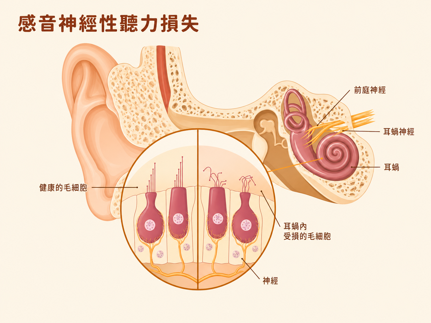 感音神經性聽力損失示意圖:展示內耳耳蝸結構、前庭神經與耳蝸神經的解剖位置,以及健康毛細胞與受損毛細胞的對比